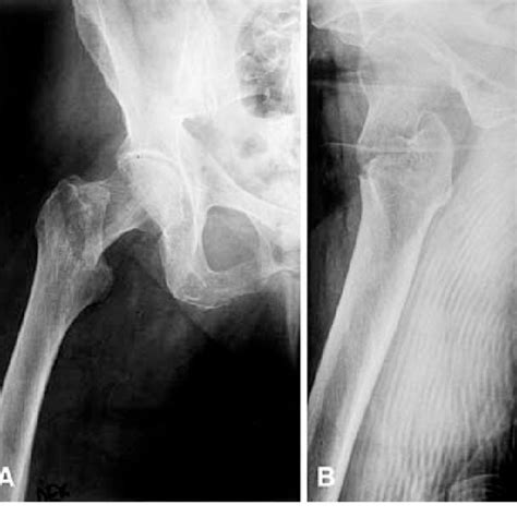 (PDF) Basicervical fracture - A rare type of hip fracture