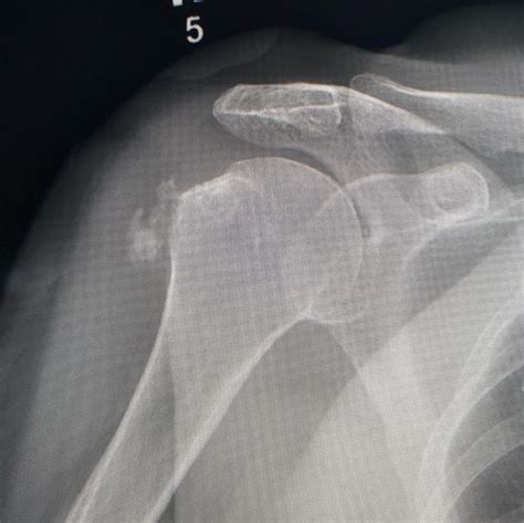 Calcific Bursitis! Hydroxyapatite deposition disease - Radiology - www ...