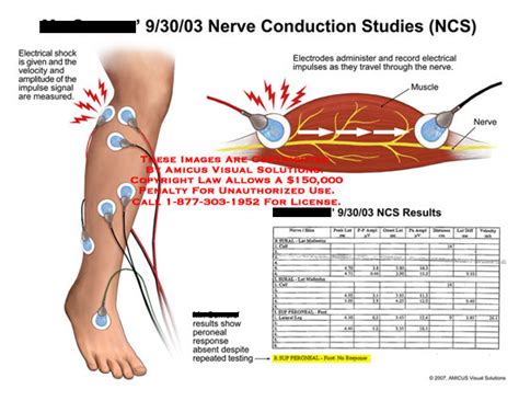 Is a emg nerve test painful - vsamobility