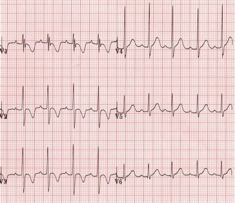 Inverted T waves are seen in the following conditions: Normal finding in children Persistent ...