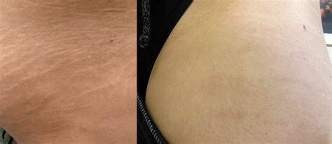 Laser Stretch Mark Removal Treatment | London Premier Laser