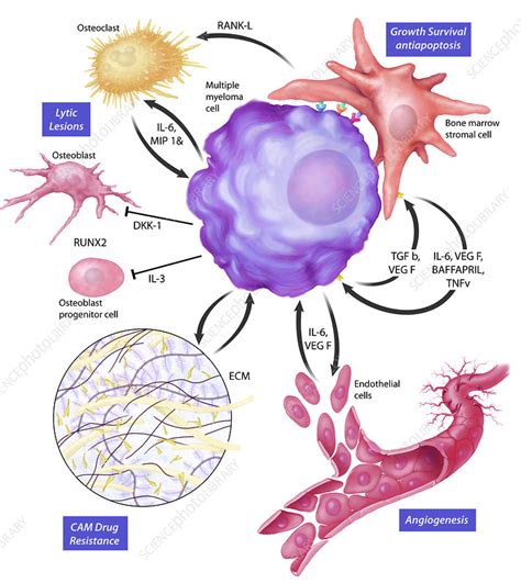 Multiple Myeloma in the bone marrow microenvironment - Stock Image ...