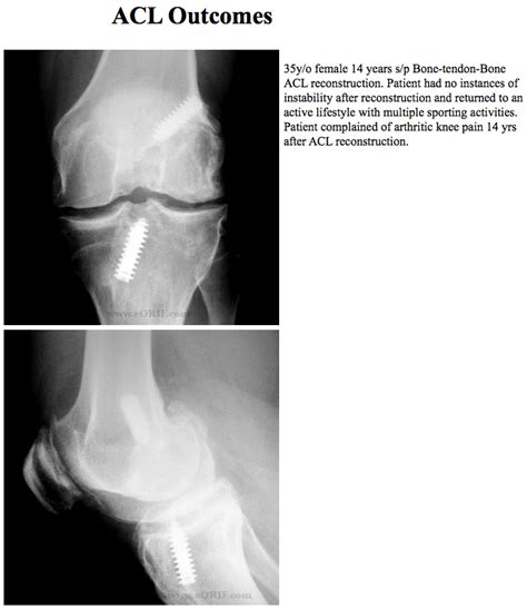 ACL Complications | eORIF