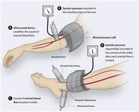 Ankle brachial index