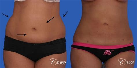 Liposuction Before & After Gallery: Patient 17