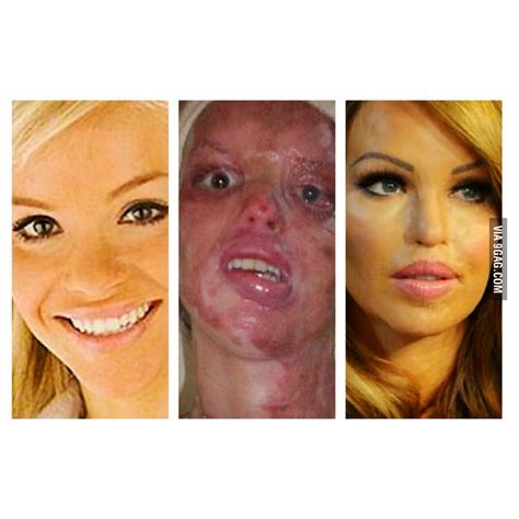 Amazing recovery of model Katie Piper before and after an acid attack. - 9GAG