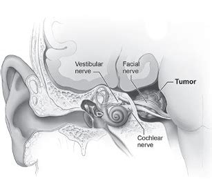 Vestibular Schwannoma – The Dizzy Neurologist