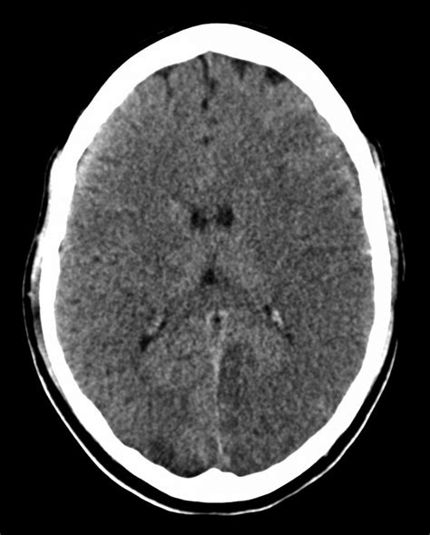 Acute infarct – CT - Radiology at St. Vincent's University Hospital