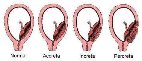 20+ Placenta Accreta ideas | placenta accreta, placenta, infertility quotes