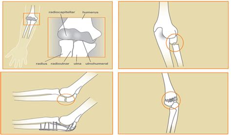 Elbow Fractures - Richard Stephen Gilbert, M.D.