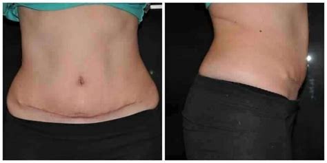 Tummy tuck scar after surgery » Tummy Tuck: Prices, Photos, Reviews, Info, Q&A