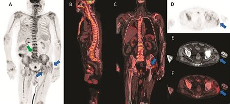Fluorine-18-FDG PET/CT scan (A) MIP, (B) sagittal fusion, (C) coronal... | Download Scientific ...
