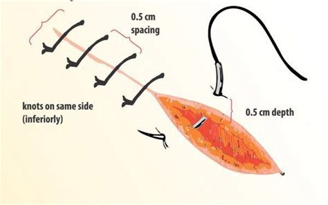 Suturing techniques - GMD GROUP