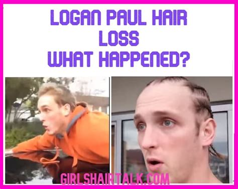 Logan Paul Hair Loss What Happened?