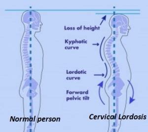 Cervical Lordosis - Reversal, Images, Treatment, Causes