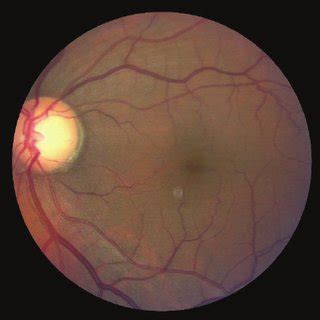 Color Fundus photograph of the left eye showed normal optic disc, and... | Download Scientific ...