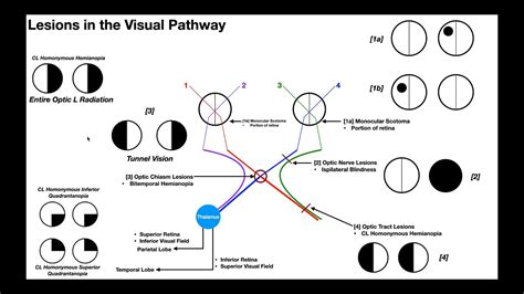 Visual Pathway Lesions And Field Defects Youtube The Best Porn Website ...