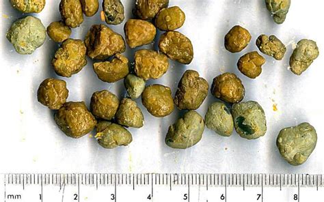 Namuong Bato sa Apdo o Gallstones — Narito ang Natural at Mas Ligtas na Paraan Upang Matanggal ...