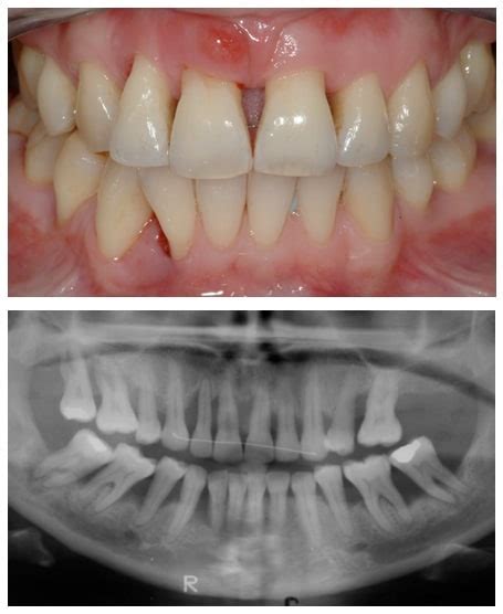 Rebuilding Bone Loss in Gums - Blog | Advanced Dentistry