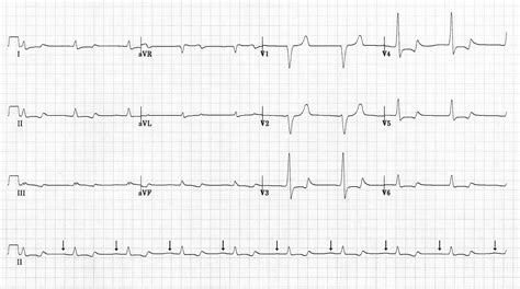 Sine-Wave Pattern Arrhythmia and Sudden Paralysis That Result From ...