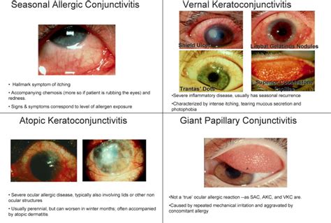 Allergic conjunctivitis: Update on pathophysiology and prospects for ...