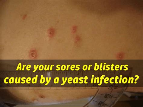 Yeast infection sores & blisters - What do yeast infection sores look like?