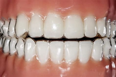 invisalign on teeth - Dentaly.org