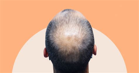 Androgenic Alopecia: Causes, Stages, & Treatments | AndSons SG