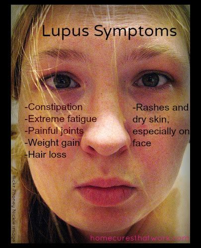 Specialty Ladies: Signs Of Lupus