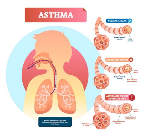 Asthma: Is It a Reversible Disease?