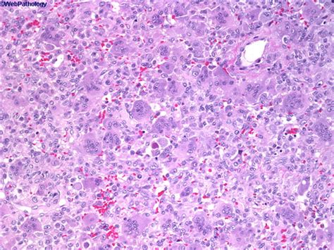 Giant Cell Tumor Histology