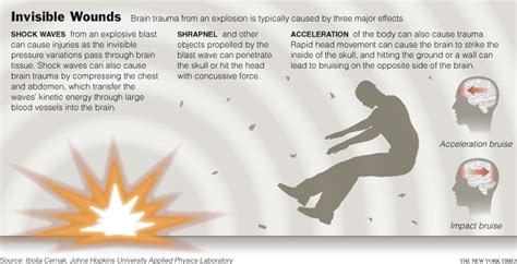 EMS SOLUTIONS INTERNATIONAL marca registrada: Blast Injuries Fact Sheets for Professionals CDC ...