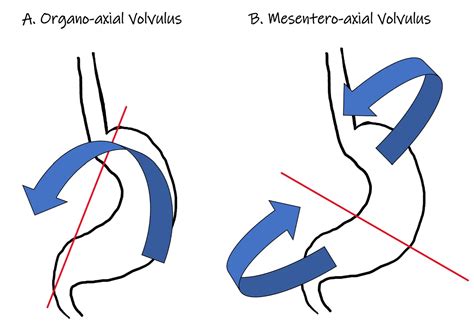 An Unusual Case of an Acute Mesenteroaxial Gastric Volvulus Secondary ...