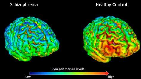 Scientists Find Key Difference In The Brains Of People With Schizophrenia in 2020 ...