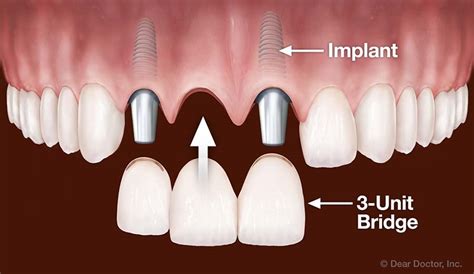 Implant Dentistry | Dr. Charles Picchioni | Bryn Mawr PA