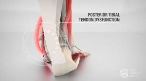 Tibialis Posterior Tendinopathy - Canberra Heel Pain Institute