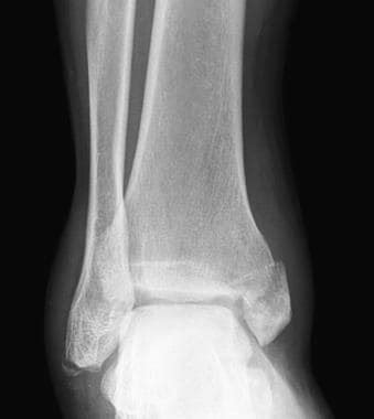 Imaging in Ankle Fractures: Overview, Radiography, Computed Tomography