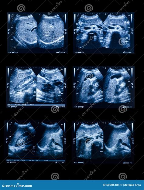 Sonography Upper Abdomen Medical Examination Stock Photo - Image of ...