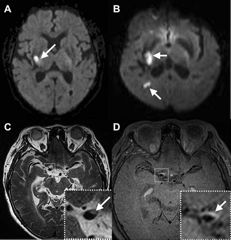 Lacunar stroke: mechanisms and therapeutic implications | Journal of ...