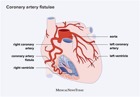 Av Fistula Heart