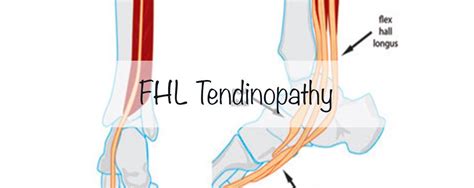 FHL Tendinopathy | Wind sock, Medical, Dance