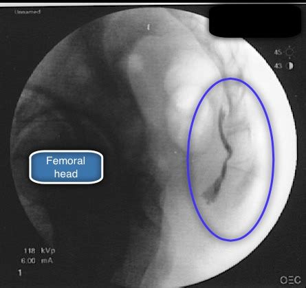 Ganglion Impar Block with Fluoroscopy - The Pain Source - Makes Learning About Pain, Painless