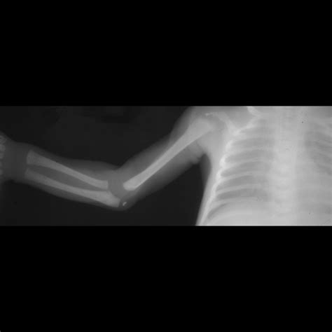 Chondrodysplasia Punctata | Pediatric Radiology Reference Article | Pediatric Imaging | @pedsimaging