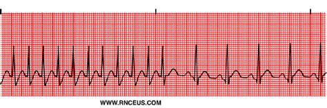 Paroxysmal Atrial Tachycardia