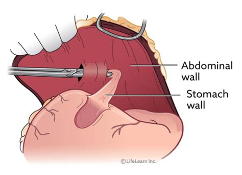 Gastric Dilatation And Volvulus (GDV): What Causes It?