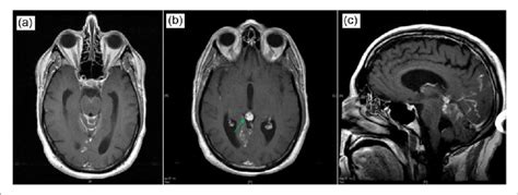 (a and b) Axial T1-post-contrast gadolinium MRI of the brain, which ...