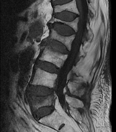 Lumbar spine fracture | Radiology Reference Article | Radiopaedia.org