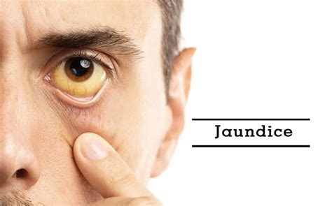 Jaundice Symptoms - Causes, Diagnosis & Treatment | Max Lab