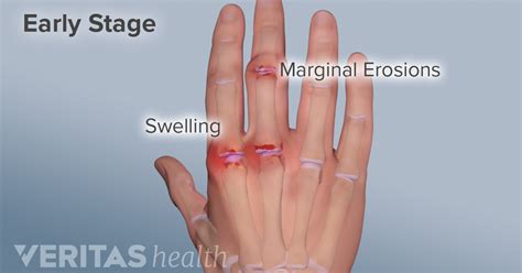 Hand rheumatoid arthritis signs and symptoms – Artofit