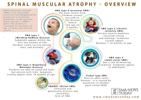 While most types of SMA typically affect children from birth, there are some types of the ...